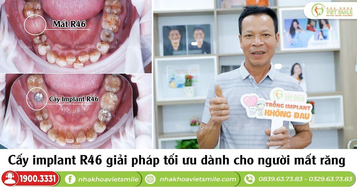 Cấy implant răng 46 - giải pháp cho người mất răng