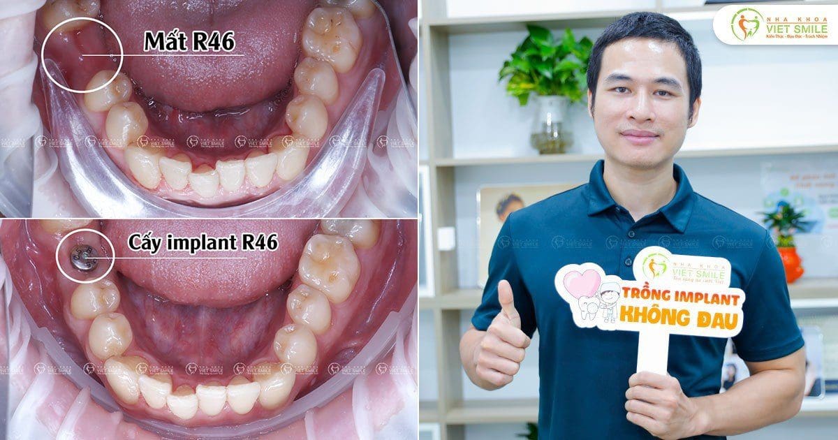 Cay implant rang46 cg4646