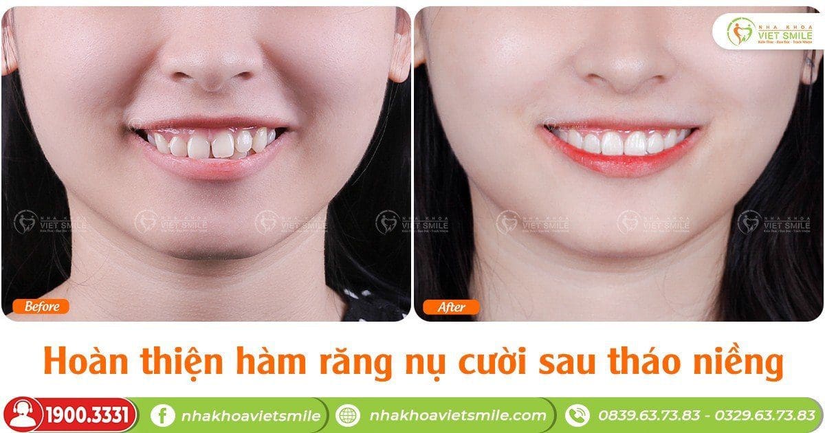 Hoàn thiện hàm răng, nụ cười sau tháo niềng