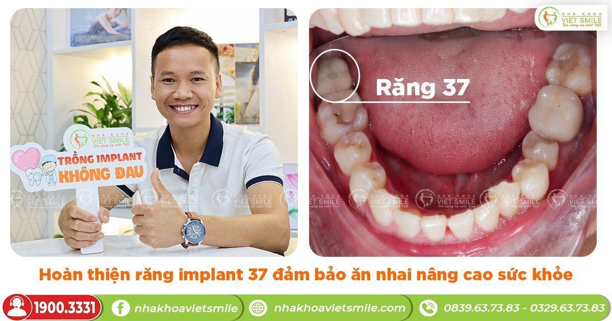 Răng hàm số 7 bị mất, cấy ghép implant cải thiện như thế nào?