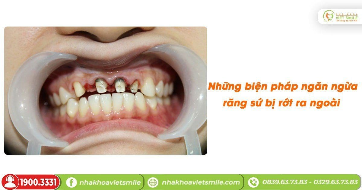 Những biện pháp ngăn ngừa răng sứ bị rớt ra ngoài