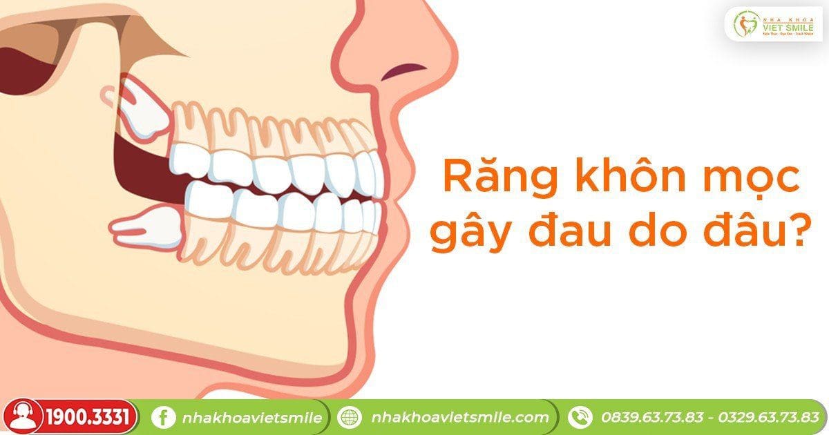 Răng khôn mọc gây đau do đâu?