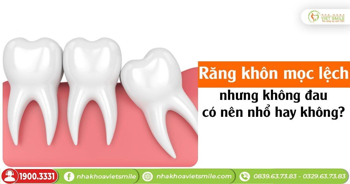 Răng khôn mọc lệch nhưng không đau có nên nhổ hay không?