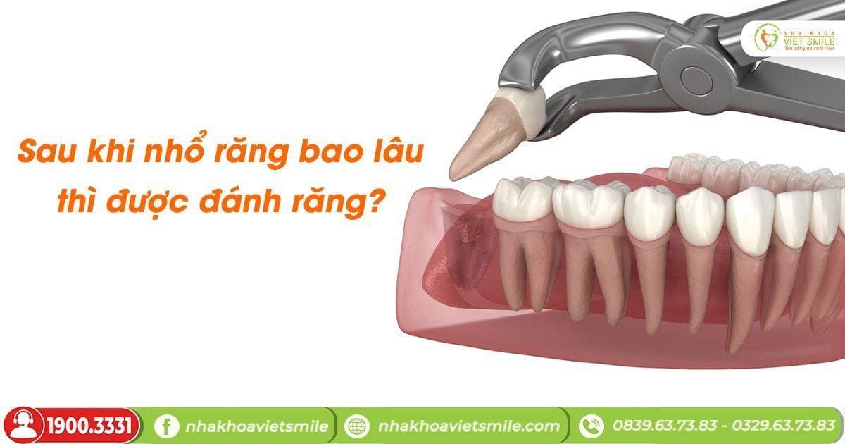 Sau khi nhổ răng bao lâu thì được đánh răng?