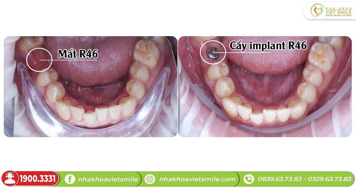 Trồng răng implant khôi phục răng mất