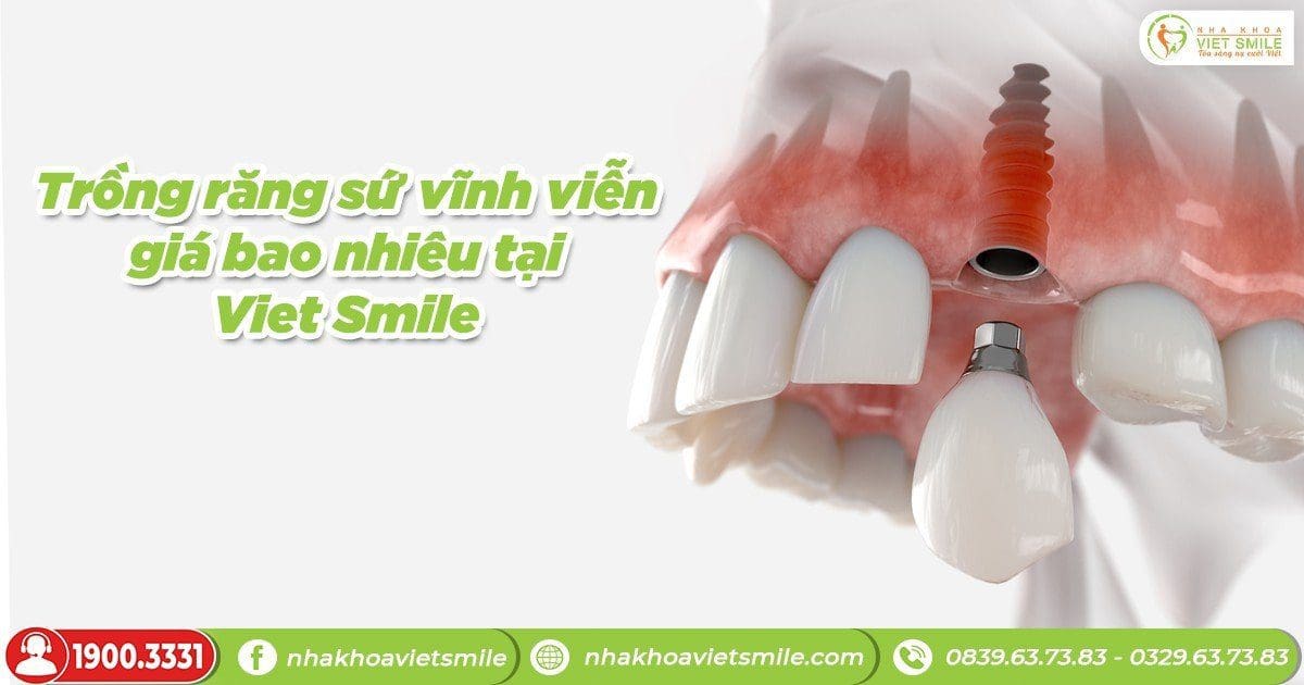 Trồng răng sứ vĩnh viễn giá bao nhiêu tại Việt Smile?