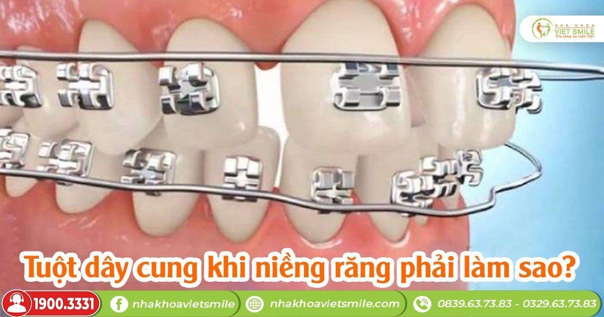 Tuột dây cung khi niềng răng phải làn sao