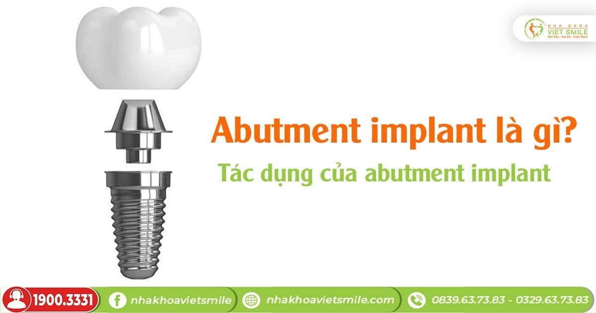 Abutment implant là gì? Tác dụng của Abutment implant