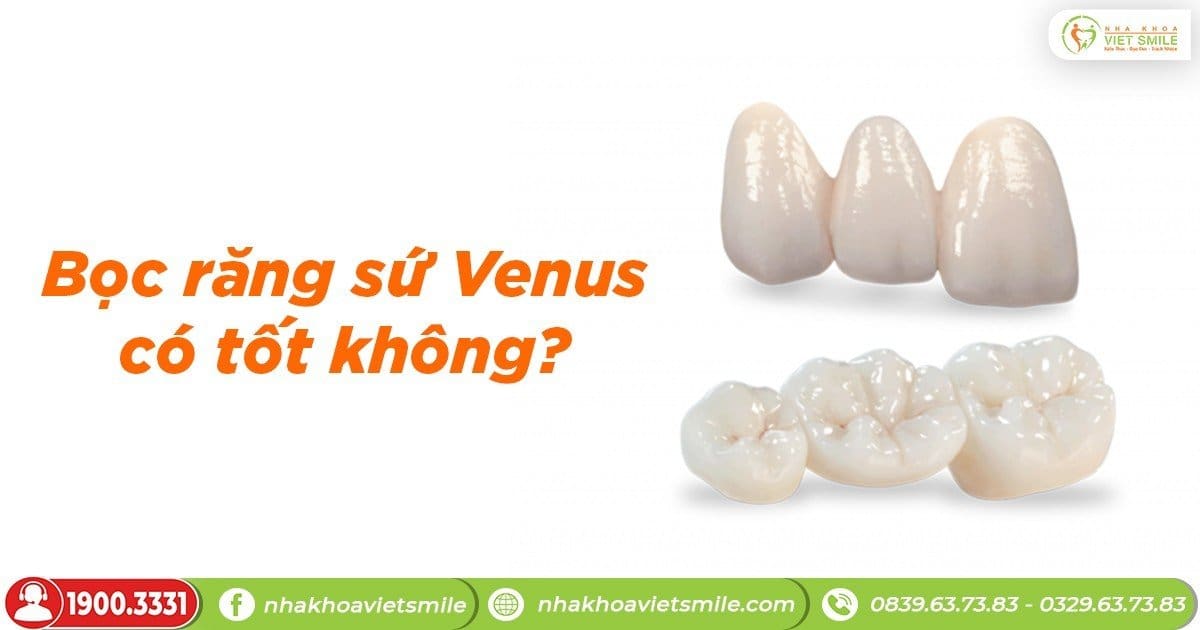 Bọc răng sứ Venus có tốt không?