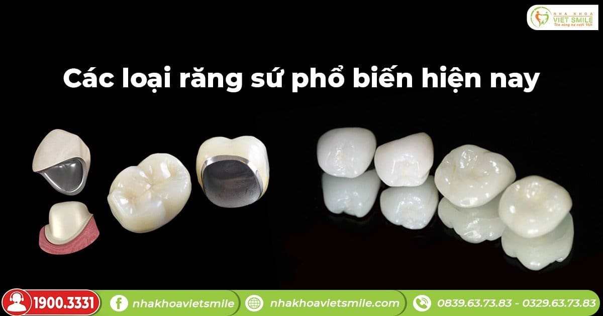 Các loại răng sứ phổ biến hiện nay