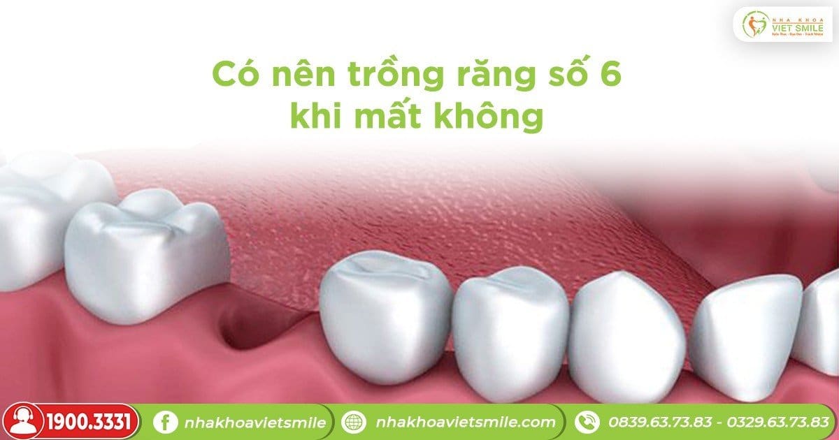 Có nên trồng răng số 6 khi mất răng không?