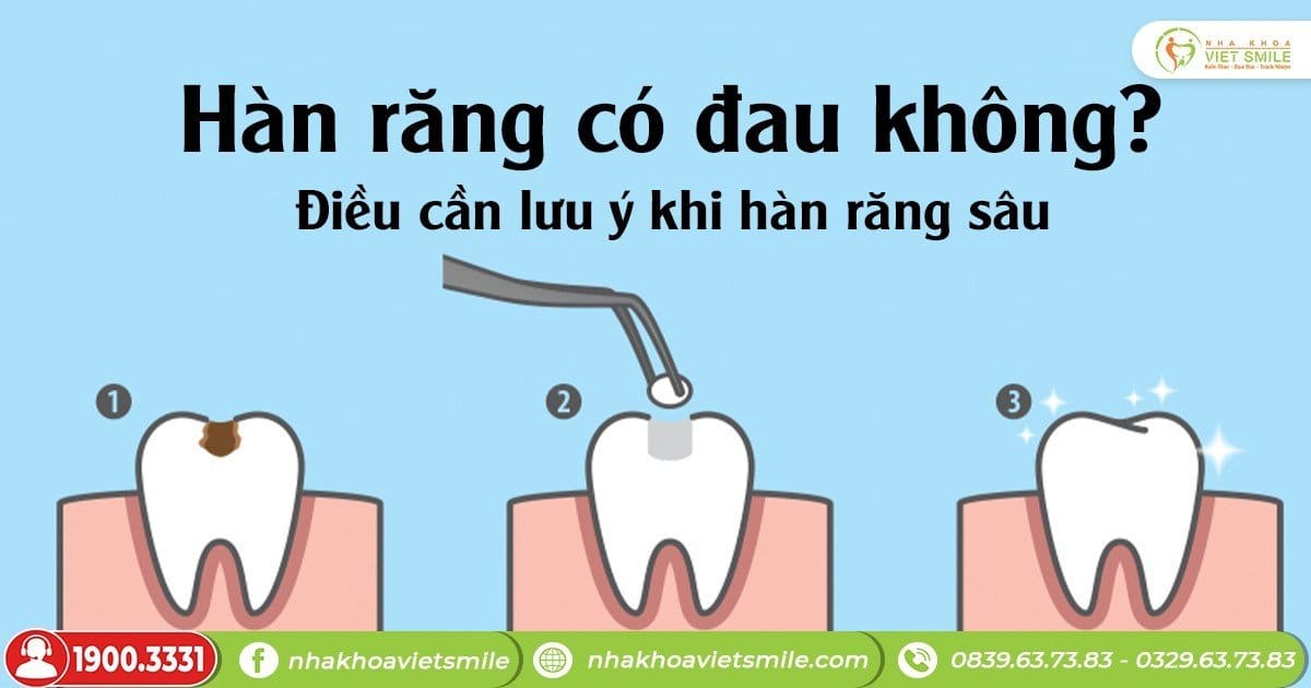 Hàn răng có đau không? Điều cần lưu ý khi hàn răng sâu