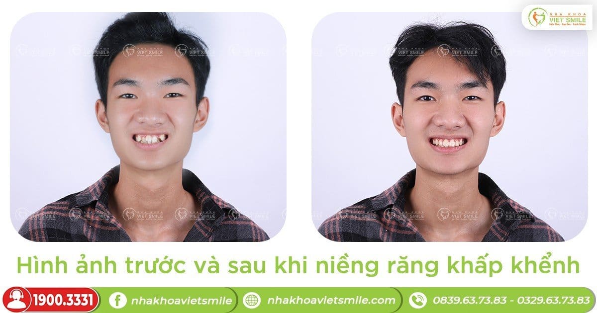 Hình ảnh trước và sau khi niềng răng khấp khểnh