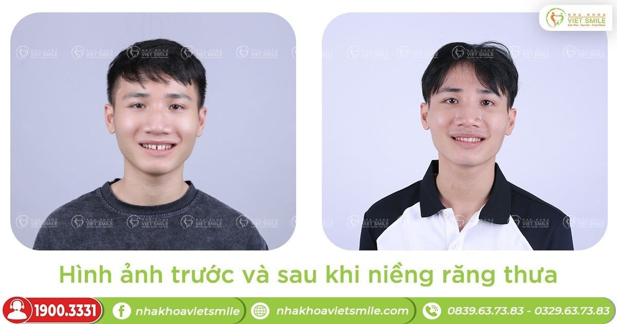 Hình ảnh trước và sau khi niềng răng thưa