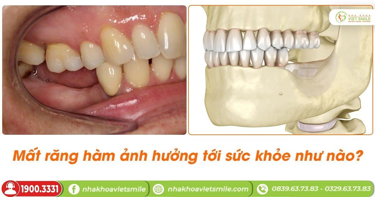 Mất răng hàm có ảnh hưởng tới sức khỏe như nào?
