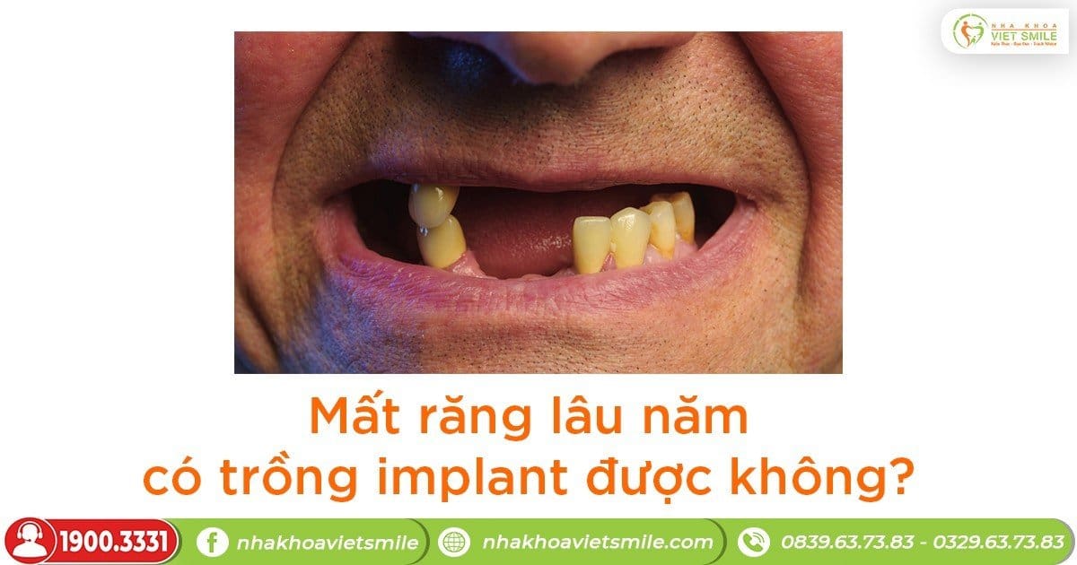 Mất răng lâu năm có trồng implant được không?