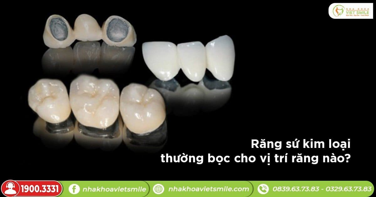 Răng sứ kim loại thường bọc cho vị trí răng nào?