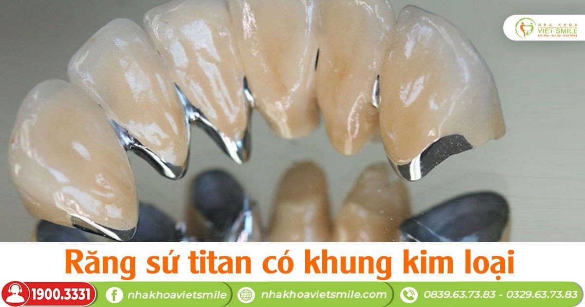 Răng sứ titan có khung kim loại