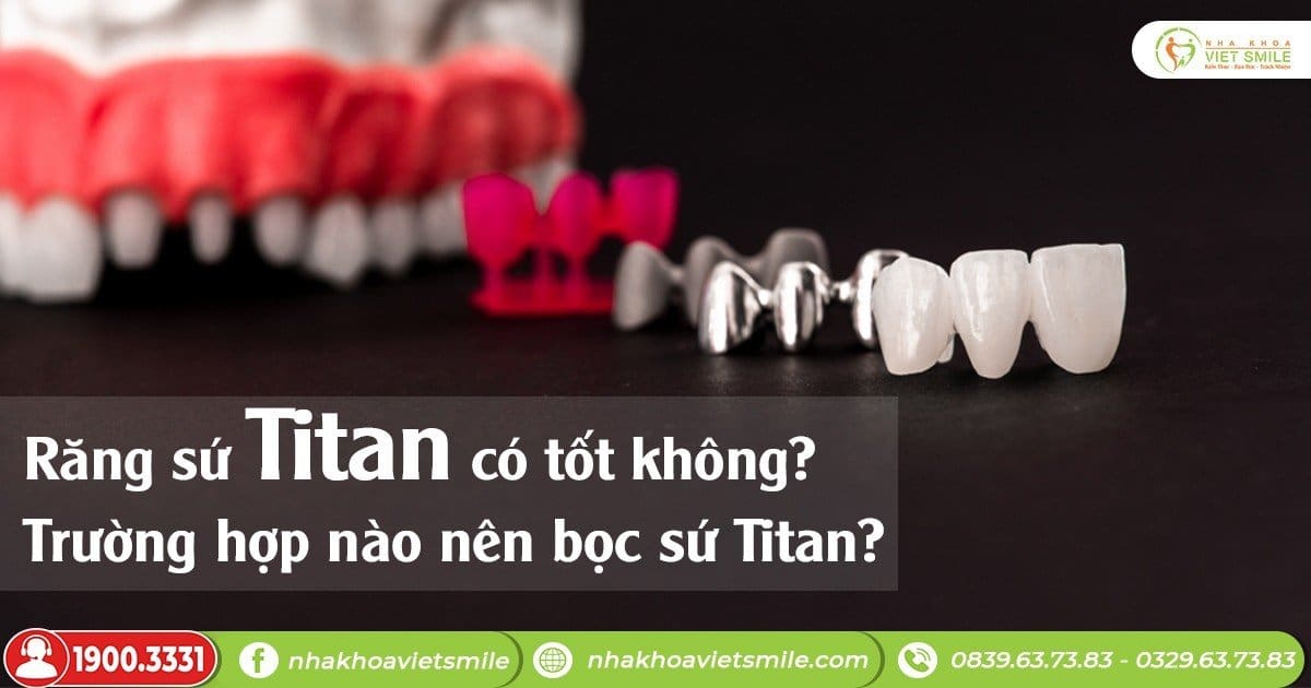 Răng sứ titan có tốt không? Trường hợp nào nên bọc sứ titan?