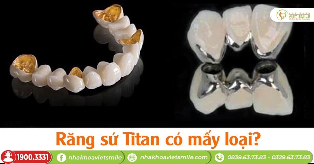 Răng sứ titan có mấy loại?