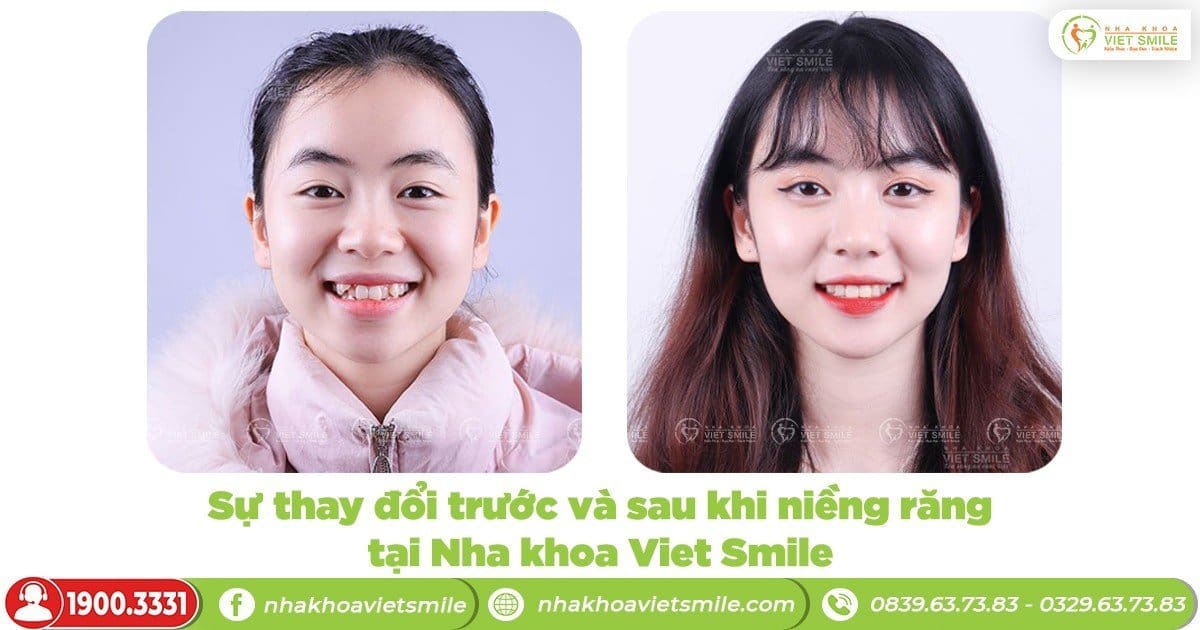 Sự thay đổi trước và sau khi niềng răng tại Nha khoa Việt Smile