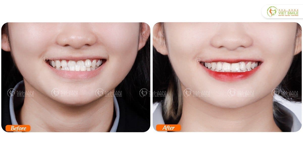 Trước và sau khi niềng răng tại viet smile