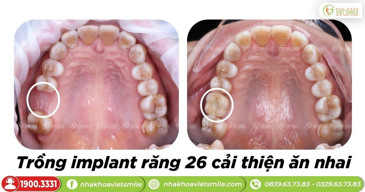Trồng implant răng 26 ăn nhai trọn vẹn