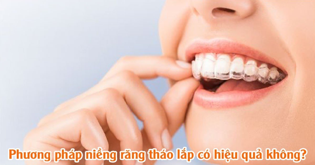 Phương pháp niềng răng tháo lắp có hiệu quả không?
