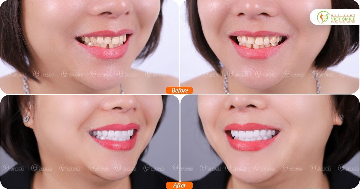 Bọc răng sứ khắc phục răng ố vàng