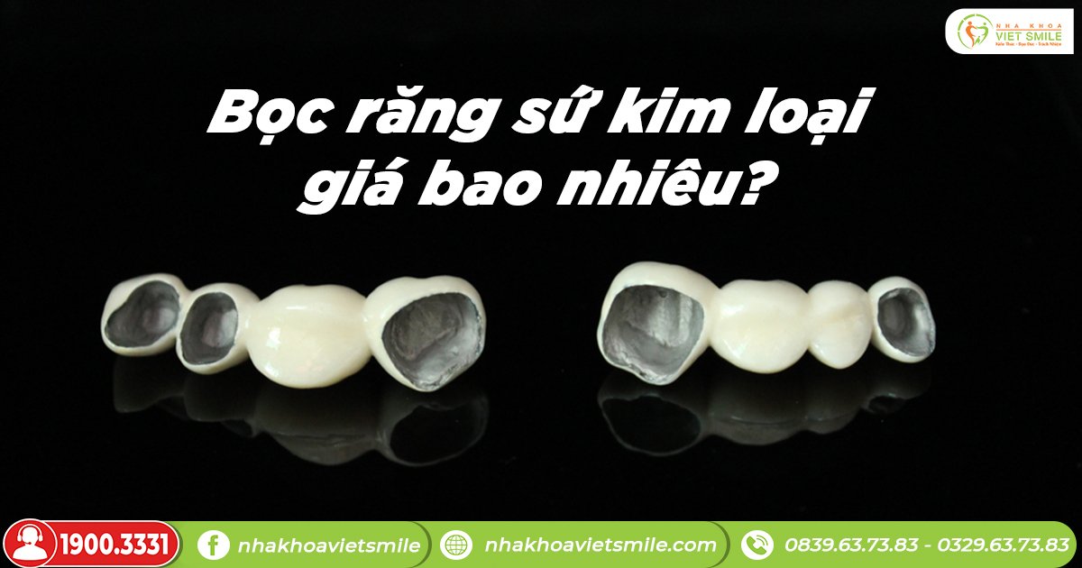 Bọc răng sứ kim loại giá bao nhiêu tiền?