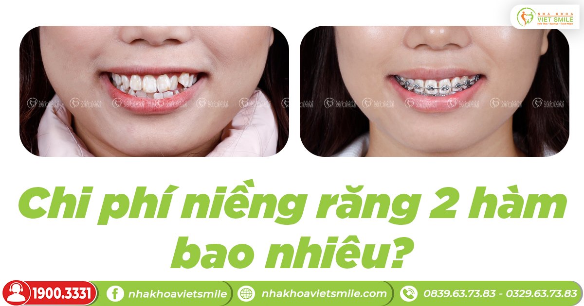 Chi phí niềng răng 2 hàm bao nhiêu?
