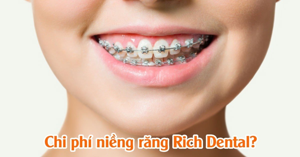Chi phí niềng răng Rich Dental bao nhiêu?