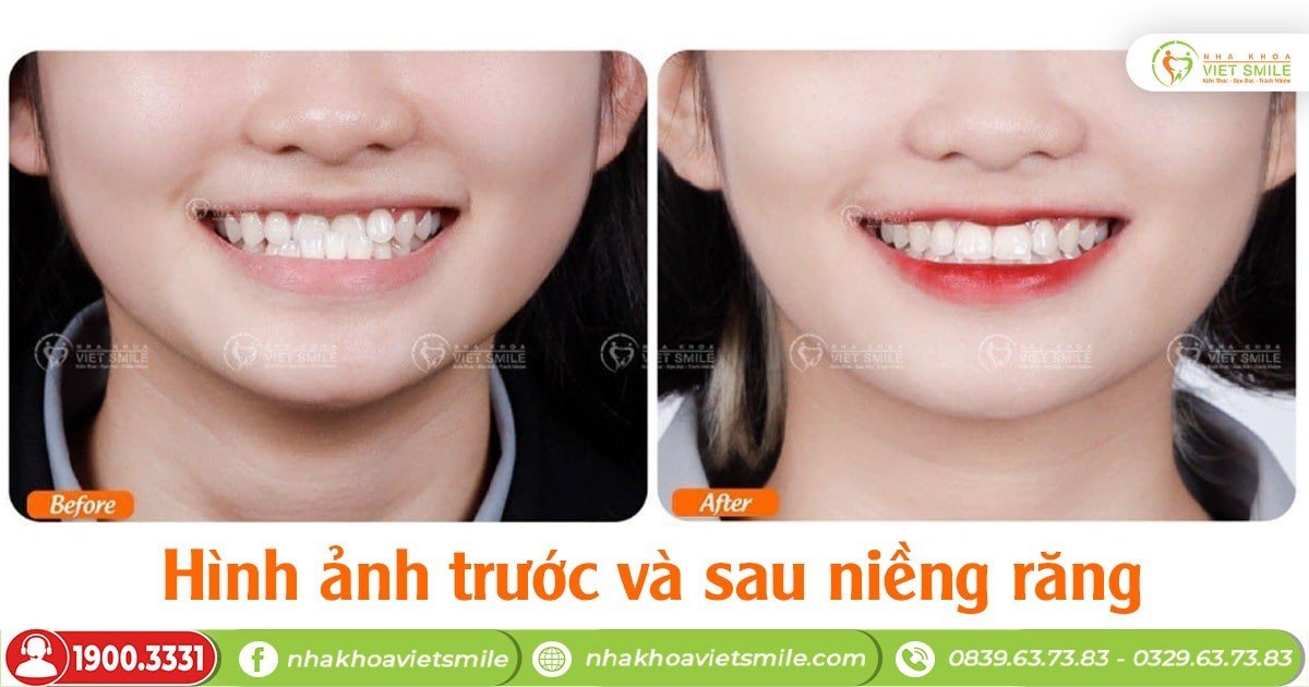 Hình ảnh trước và sau niềng răng