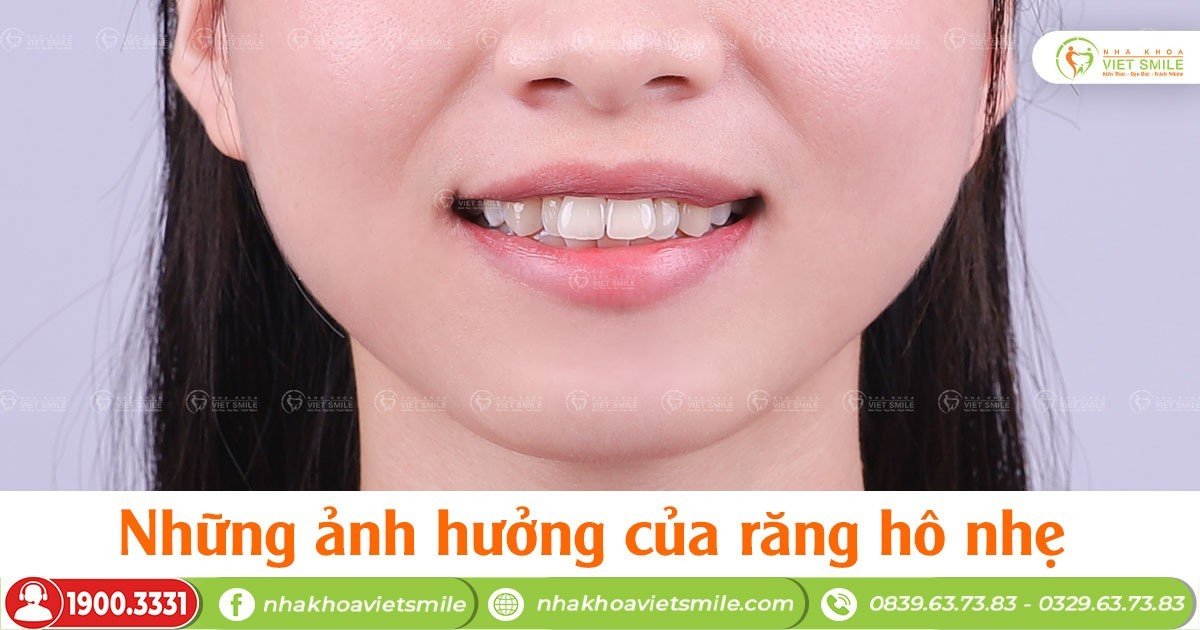 Những ảnh hưởng của răng hô nhẹ