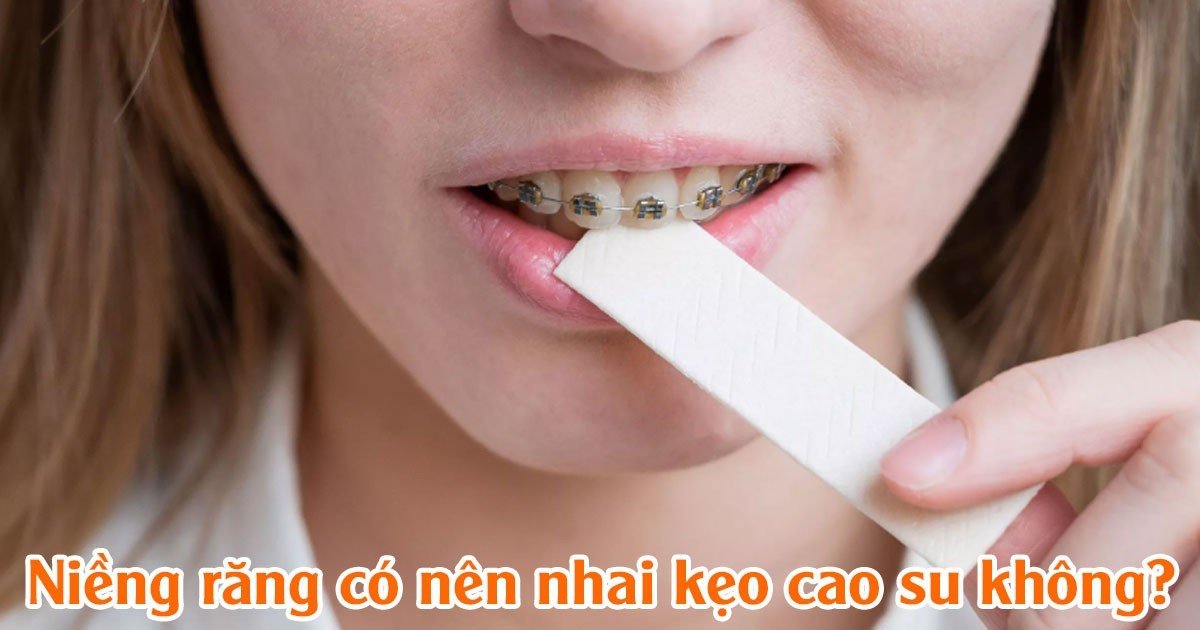Niềng răng có nên nhai kẹo cao su không?