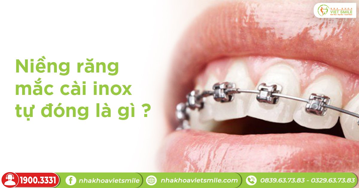 Niềng răng mắc cài inox tự đóng là gì?