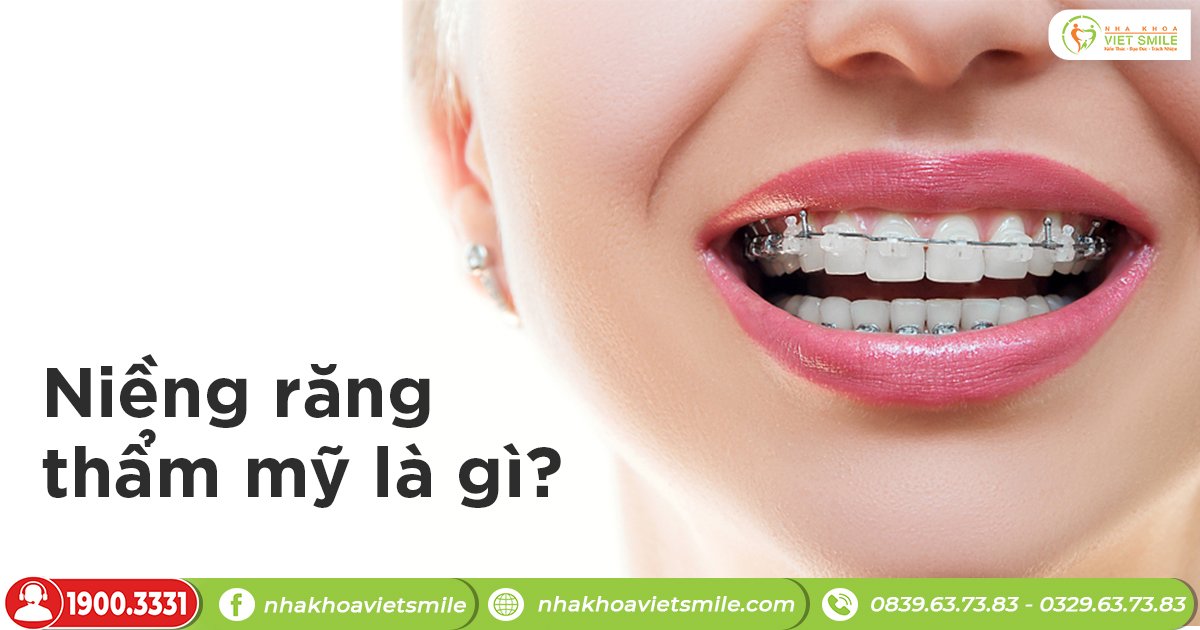Niềng răng thẩm mỹ là gì?