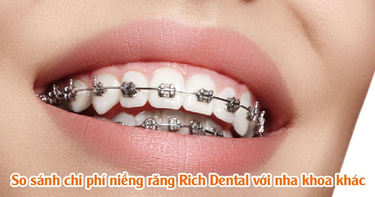 So sánh chi phí niềng răng Rich Dental với nha khoa khác