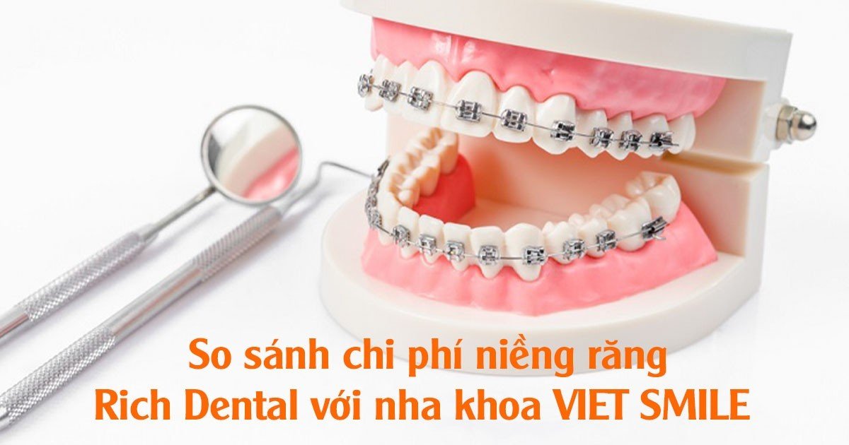 So sánh chi phí niềng răng Rich Dental với nha khoa VIET SMILE