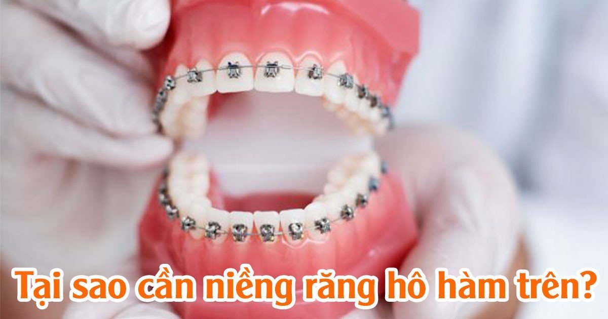 Tại sao cần niềng răng hô hàm trên?