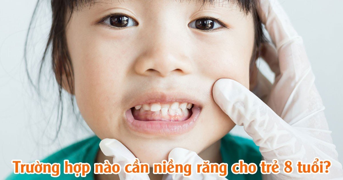 Trường hợp nào cần niềng răng cho trẻ 8 tuổi?