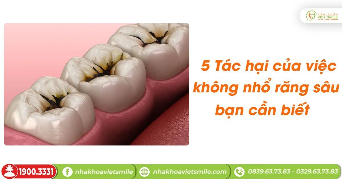 5 tác hại của việc không nhổ răng sâu bạn cần biết