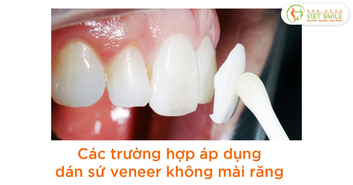 Trường hợp nào có thể dán sứ không mài răng