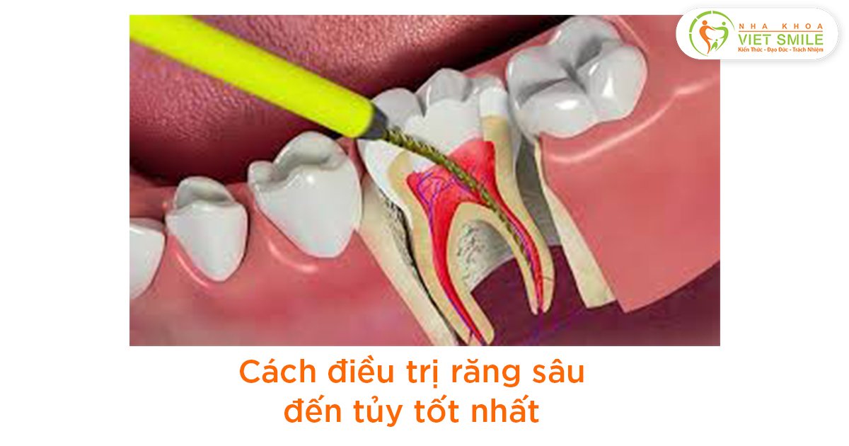 Cách điều trị răng sâu đến tủy tốt nhất