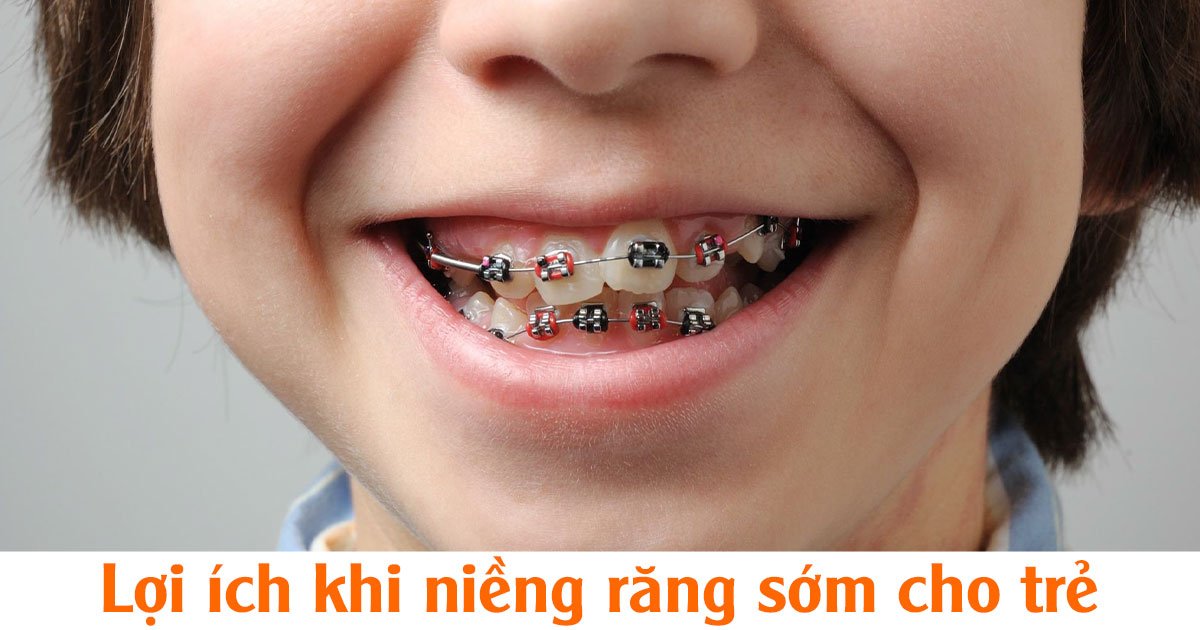 Lợi ích khi niềng răng sớm cho trẻ