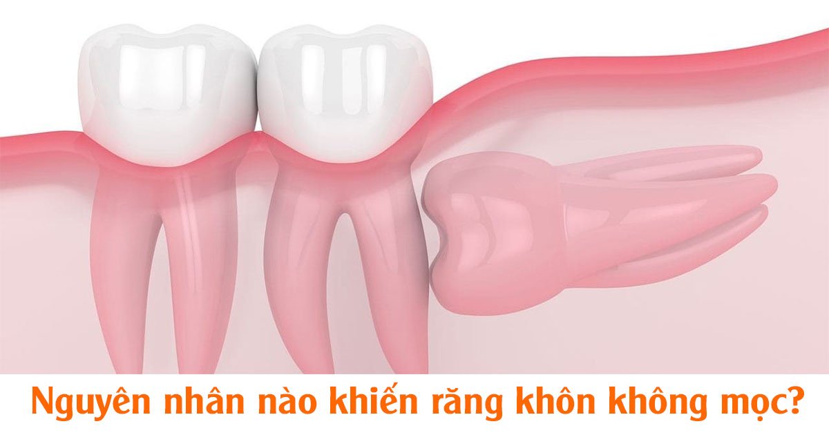 Nguyên nhân nào khiến răng khôn không mọc?