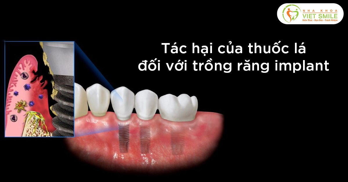Tác hại của thuốc lá đối với trồng răng Implant