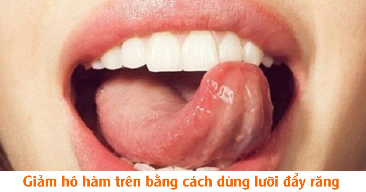 Giảm hô hàm trên bằng cách dùng lưỡi đẩy răng