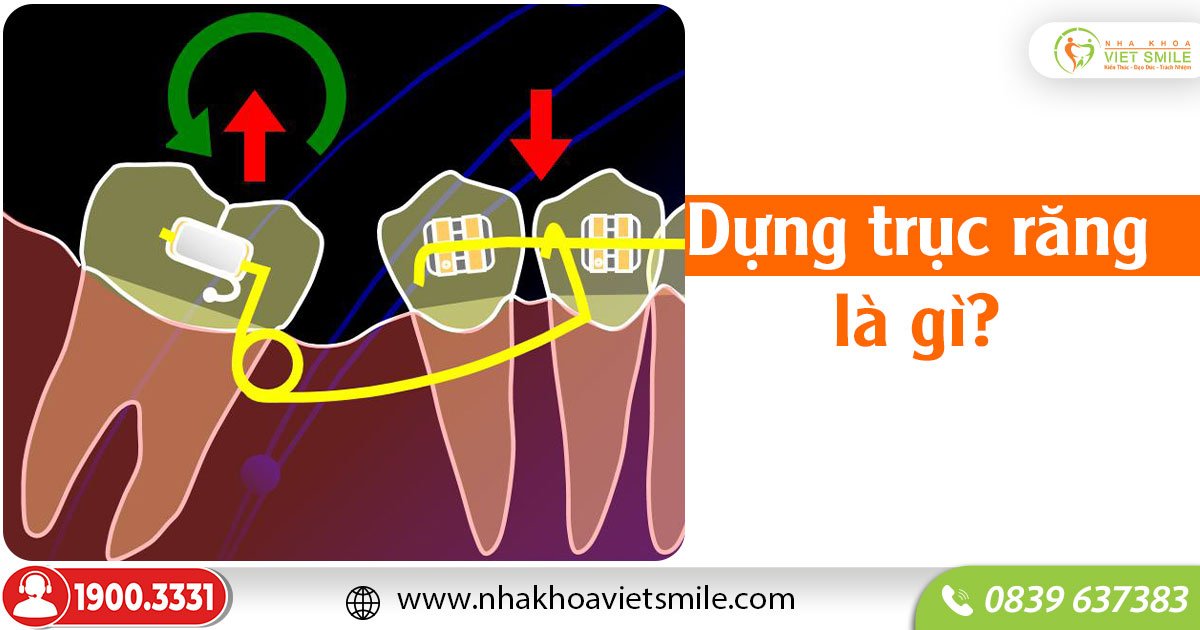 Dựng trục răng là gì?