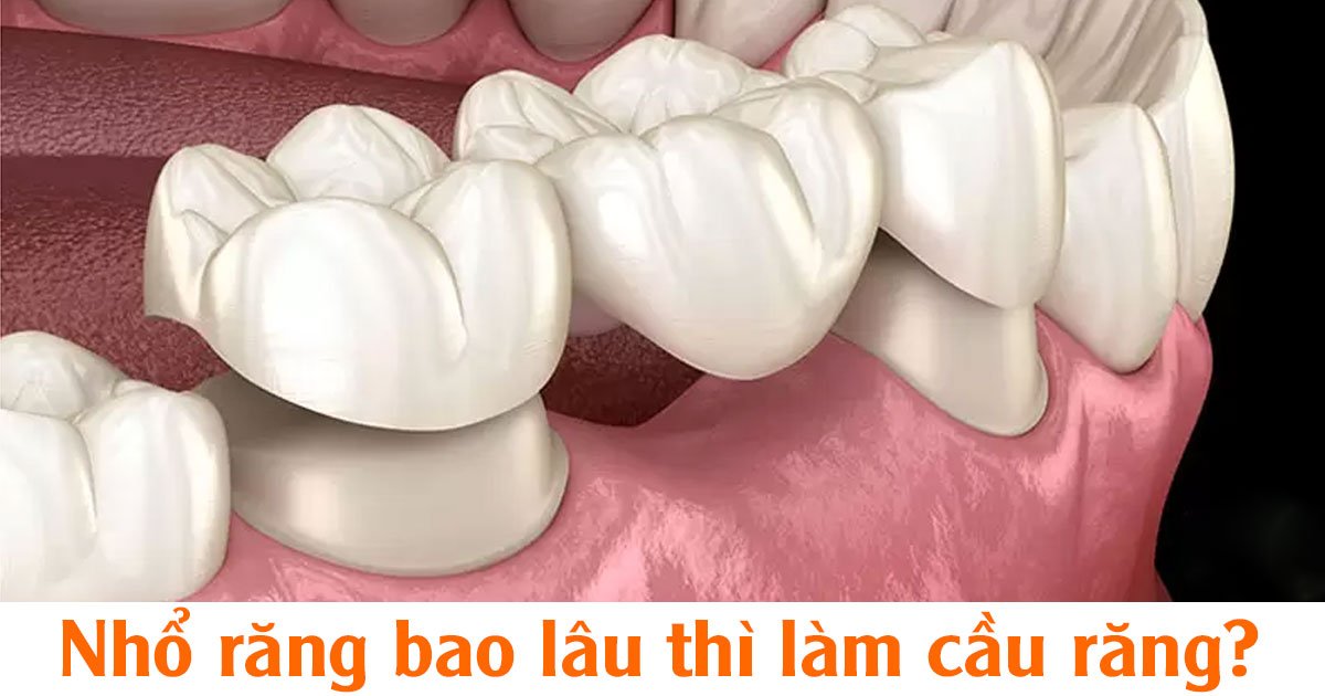 Nhổ răng bao lâu thì làm cầu răng?